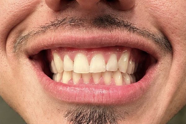 Client smile before LED teeth whitening, with yellowed front teeth