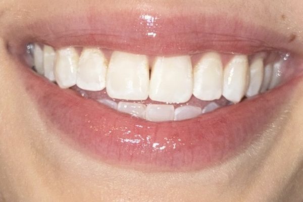 The same client after whitening, brighter natural smile