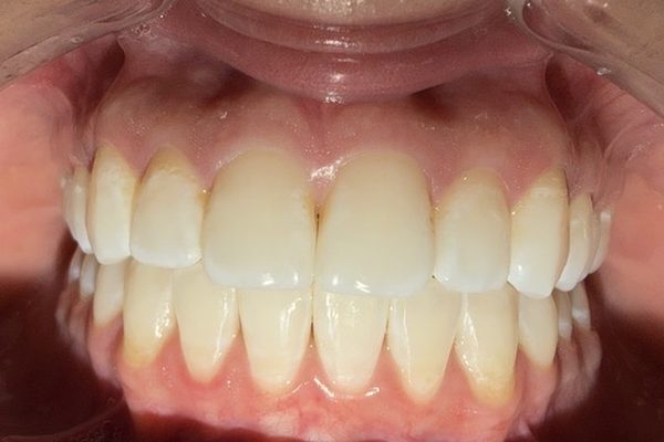 Client teeth before whitening, photographed with a cheek retractor