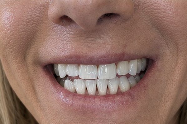 The same client after whitening at Certified Glow Studio, whiter, even shade