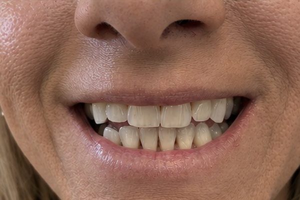 Client smile before teeth whitening, light yellow staining