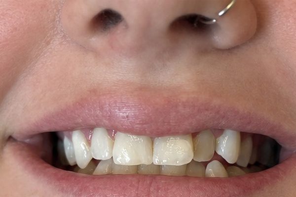 The same client after whitening, staining visibly lifted