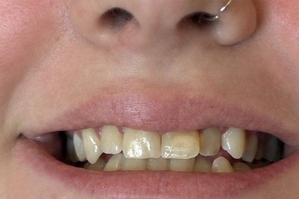 Client smile before whitening, visible yellow staining on front teeth